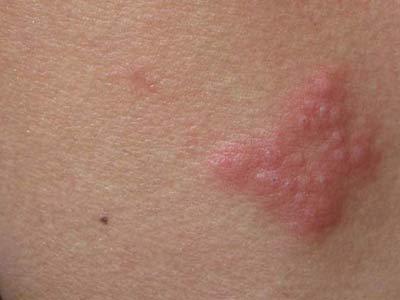 蛇盘疮初期图片