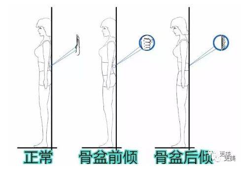 造成腰椎不正常的生理前凸,若小腹前凸,腰椎前凸,基本就属于骨盆前倾