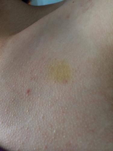 突然有的黄斑 长黄斑的原因有什么?会怎么样?