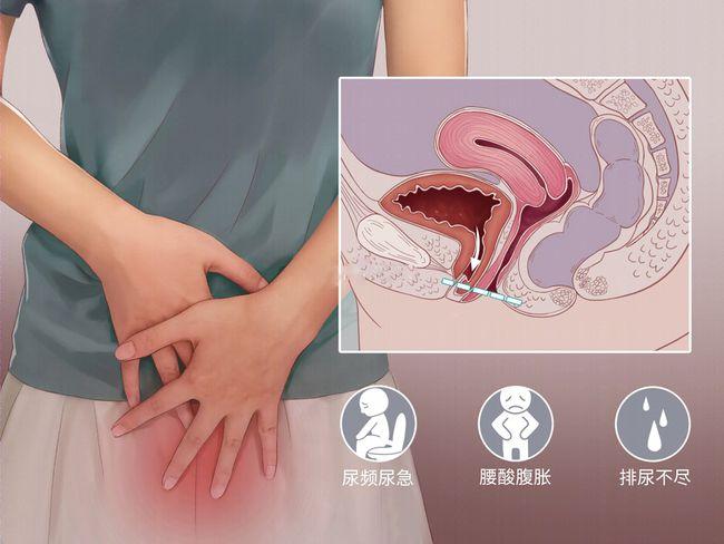 女性盆底功能障碍性疾病|子宫|直肠|尿道|盆腔_网易