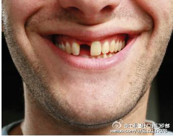 牙齿缺失,缺一个带走俩!