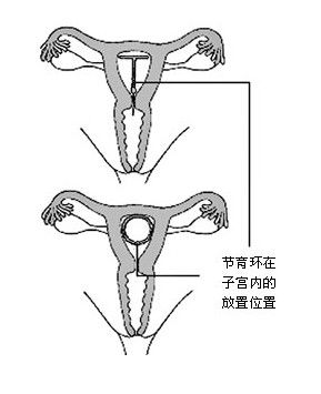 上环为什么可以避孕
