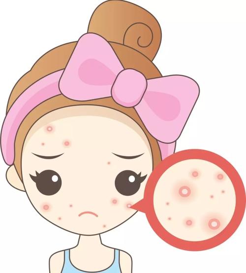 青春痘患者如何中医治疗以及怎样做好护理呢?