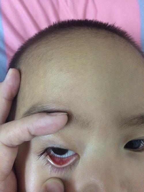 有宝宝得霰粒肿么?有懂得帮帮忙