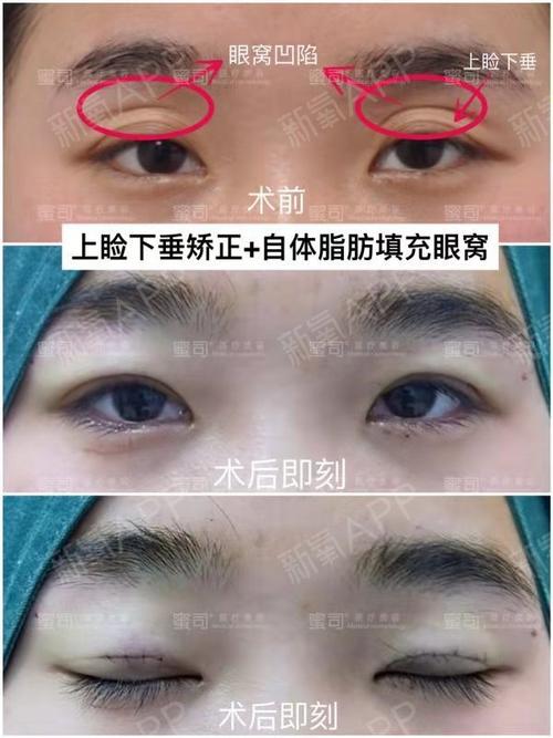 眼窝凹陷如何改善?