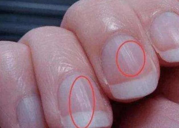 指甲出现竖纹是什么原因?多数和3种状况相关,不妨了解