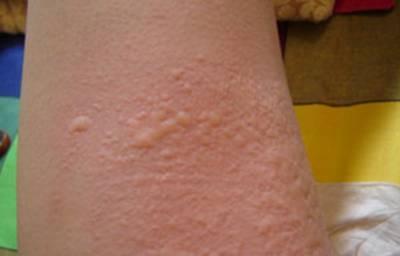 北京京城皮肤病医院 荨麻疹 荨麻疹症状 正文   荨麻疹的症状特点是