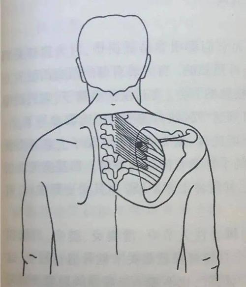菱形肌上后锯肌损伤
