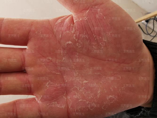 剥脱性角质松解症是好发于掌趾部表浅皮肤的角质剥脱性