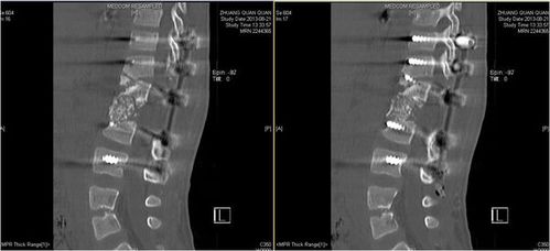 先天性脊柱后凸-7岁