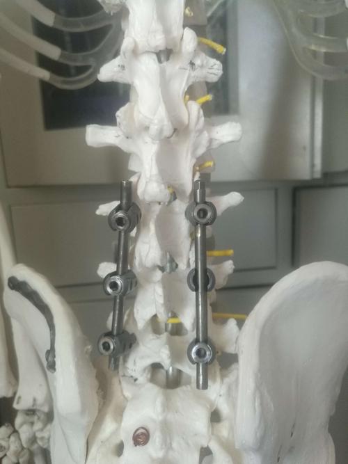 腰椎经椎弓根螺钉固定~可以治疗,椎体骨折,腰椎椎间盘突出,椎管狭窄