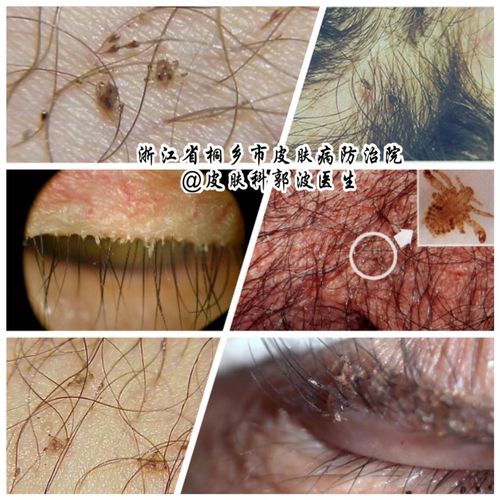 难言之隐阴虱病