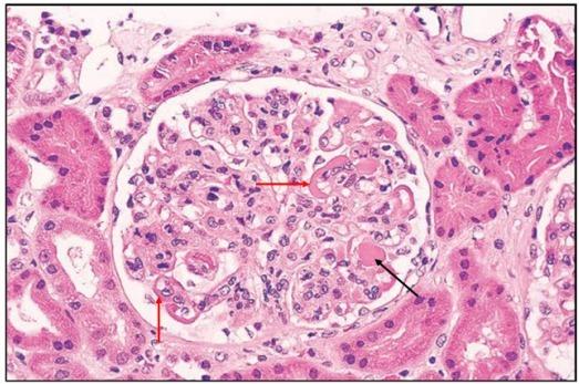 he 染色 黑色箭头:肾小球毛细血管腔内的透明样血栓;红色箭头:内
