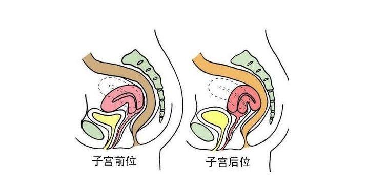 子宫后位难怀孕?真有其事还是谣言?专家说