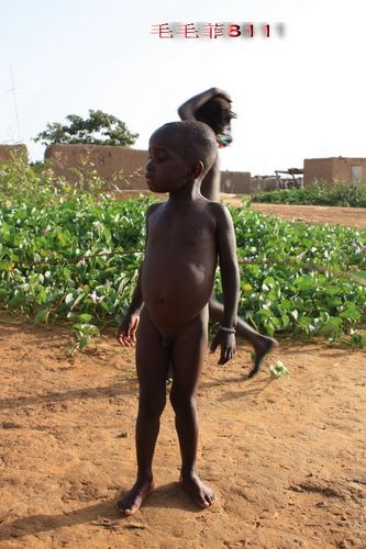      非洲小孩普遍是大肚子,应该