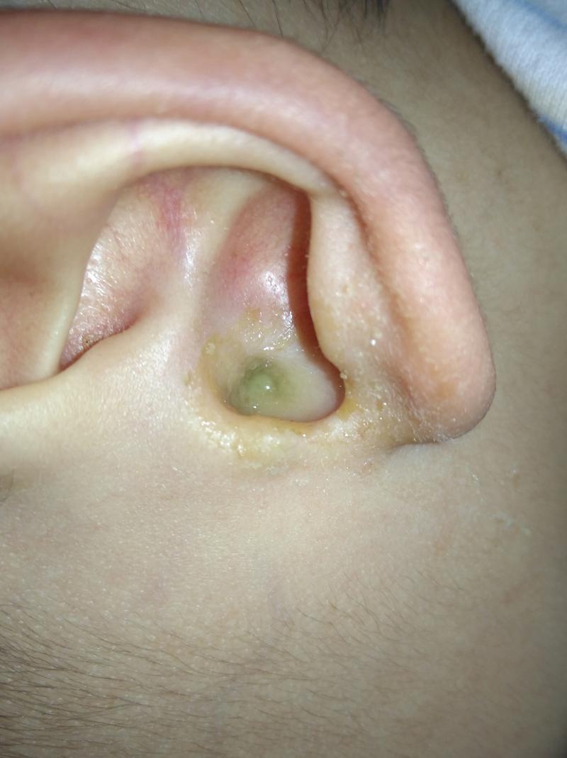 宝宝这几天发烧,耳朵变这样了! 是不是发炎了?一开始以为是发