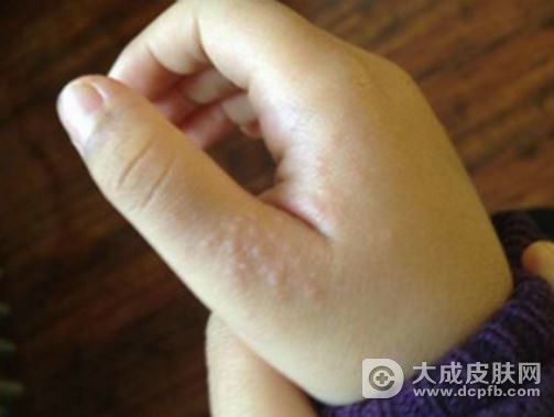 手上长湿疹怎么办教你护理方法祛湿疹