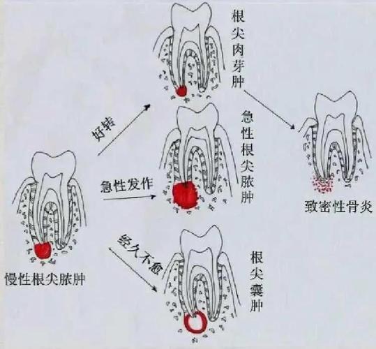 根尖周炎的疼痛特点no.