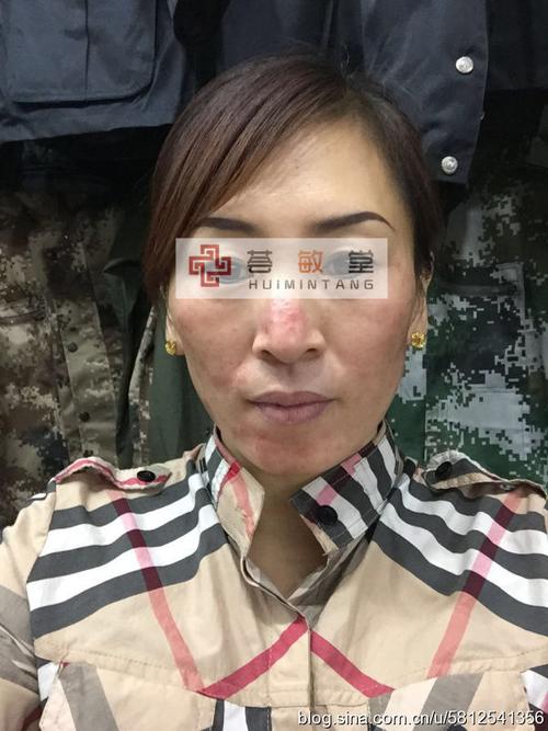 激素脸排毒过程图片