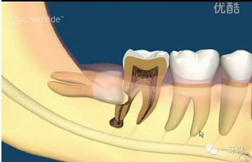 全方位科普:智齿究竟该不该拔?