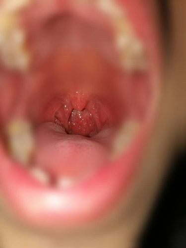 有肉疙瘩?怎么回事? 这段时间感觉喉咙眼里有异物,但不太明显.