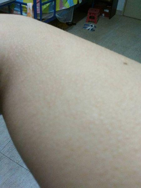 请问这是鸡皮肤么,胳膊上起了有点像鸡皮疙瘩的东西,而且还很痒,原先