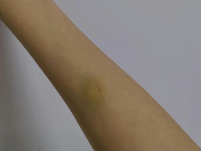 手腕好疼整根筋都在疼稍微一动都好疼胳膊还青了