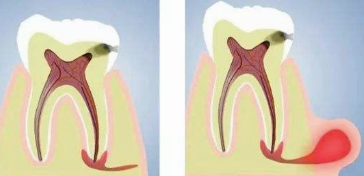 第五步 急性根尖周炎