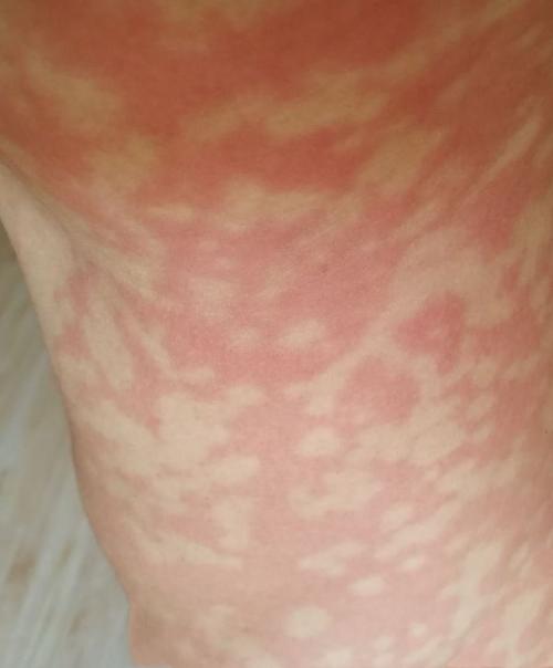 酒精过敏的人喝多了会怎么样?