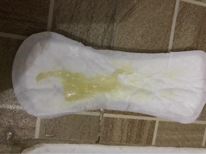 昨天做比超羊水正常