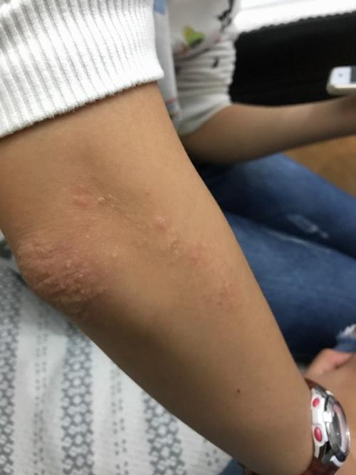 两个胳膊肘和两个膝盖膝盖上长了好多小包包,痒,请各位大神帮忙看看这