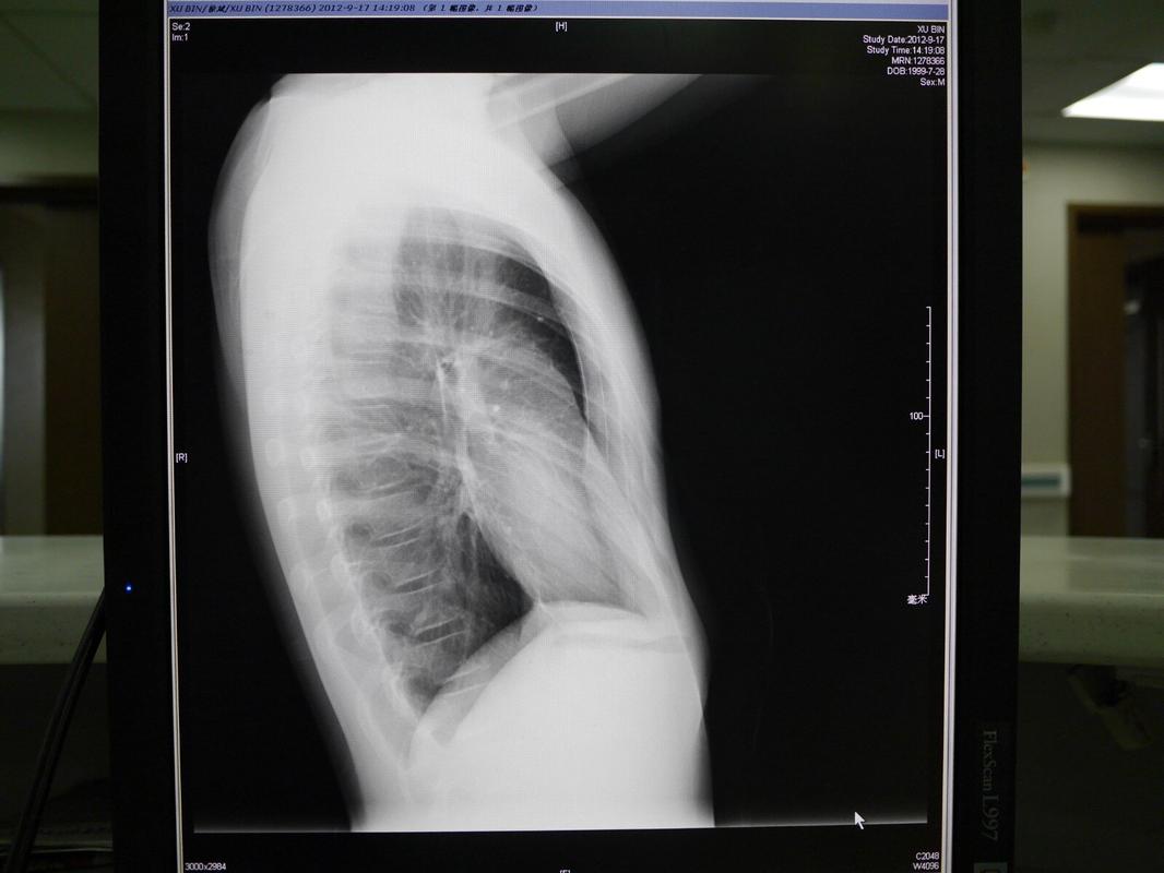 漏斗胸患者的常见症状及体征_漏斗胸 - 好大夫在线