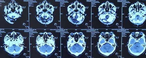 枕骨大孔区(延髓腹侧)脑膜瘤显微全切除一例