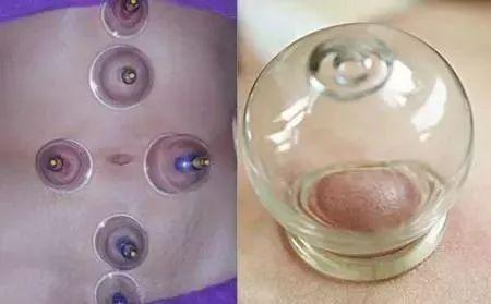 拔罐减肚子拔哪里图解 教你几种瘦身方式