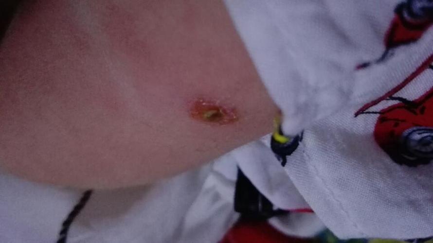 45天的宝宝胳膊上种的豆子结痂了,应该是抱的时候把结痂给弄掉了,结痂