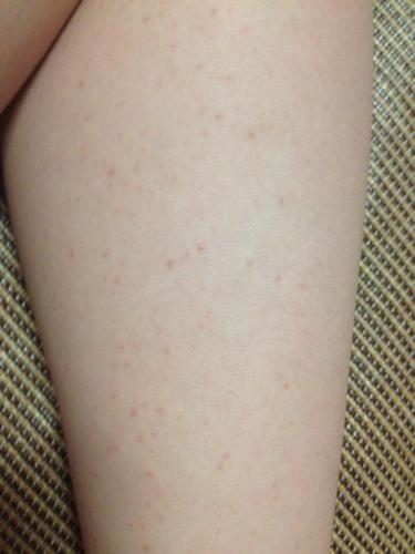 问:女儿腿上有好多小红点,是怎么回事?