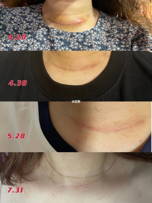 甲状腺术后刀口的变化～_甲状腺_颈纹_疤痕贴_医疗健康_医疗健康其他