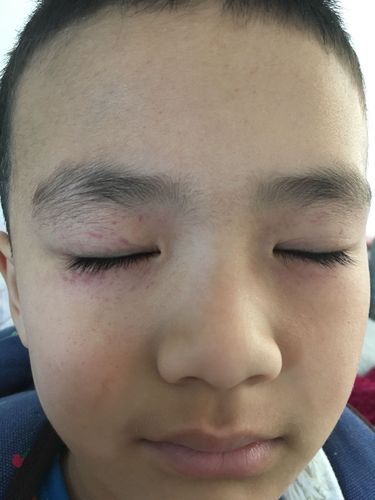 昨天晚上洗完澡眼睛周围长红点了,当时没感觉,今天早上起来有点疼有点
