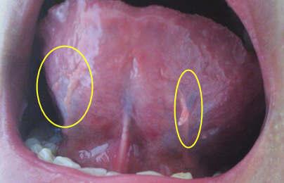 口腔尖锐湿疣图片是什么样子呢