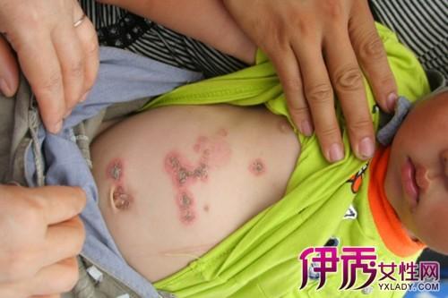 儿童肚子蛔虫图片 简单方法治疗儿童蛔虫