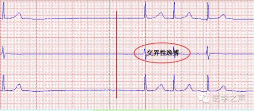 每天学看一份心电图第24期病态窦房结综合征