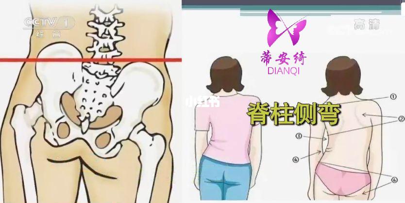 骨盆变形的危害1 骨盆变形容易导致脊椎弯曲,压迫神经