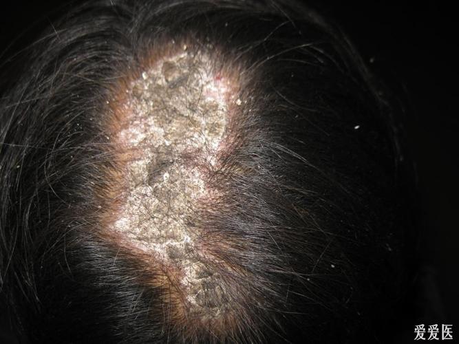[皮肤病] 头癣