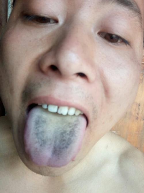 舌苔发黑是怎么回事?都七八天了!一直发黑!