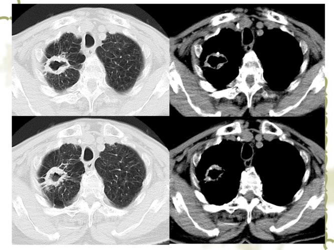 肺部空洞的鉴别诊断