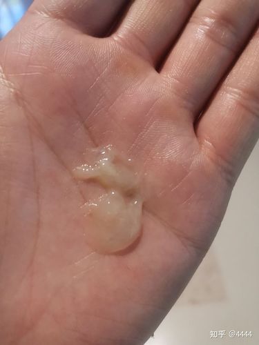 我的痰是果冻型的正常吗?