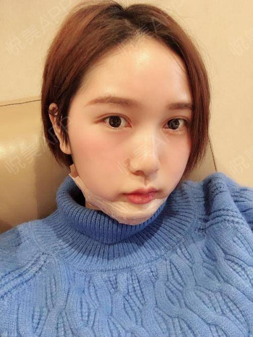 硅胶假体垫下巴术后2天_垫下巴术后2天_面部轮廓术后2天_久久分享图片