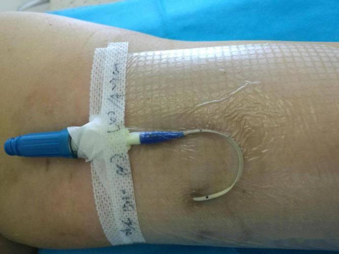 如何正确固定picc导管外露部分
