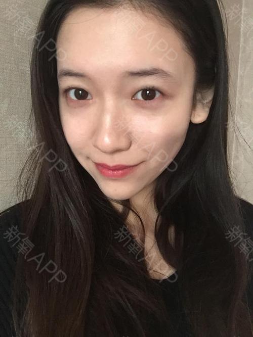 潇洒的小月月切开双眼皮第4天美丽日记