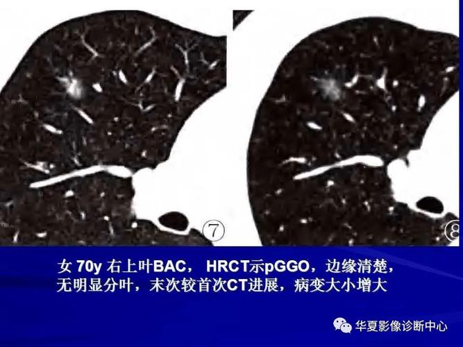 肺磨玻璃结节的ct诊断